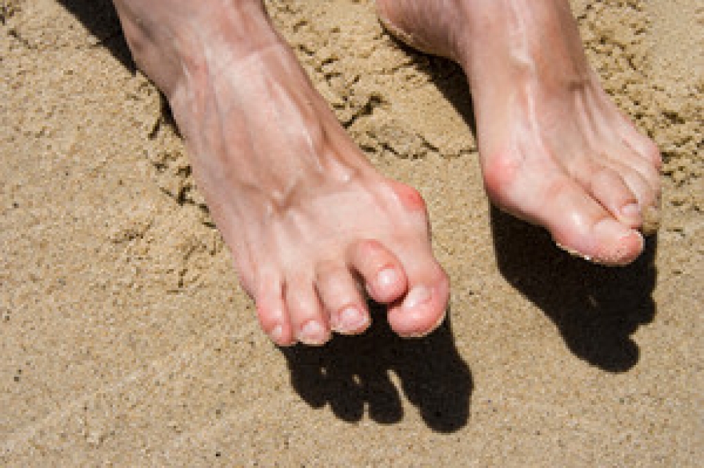 Hammertoe and Its Common Causes