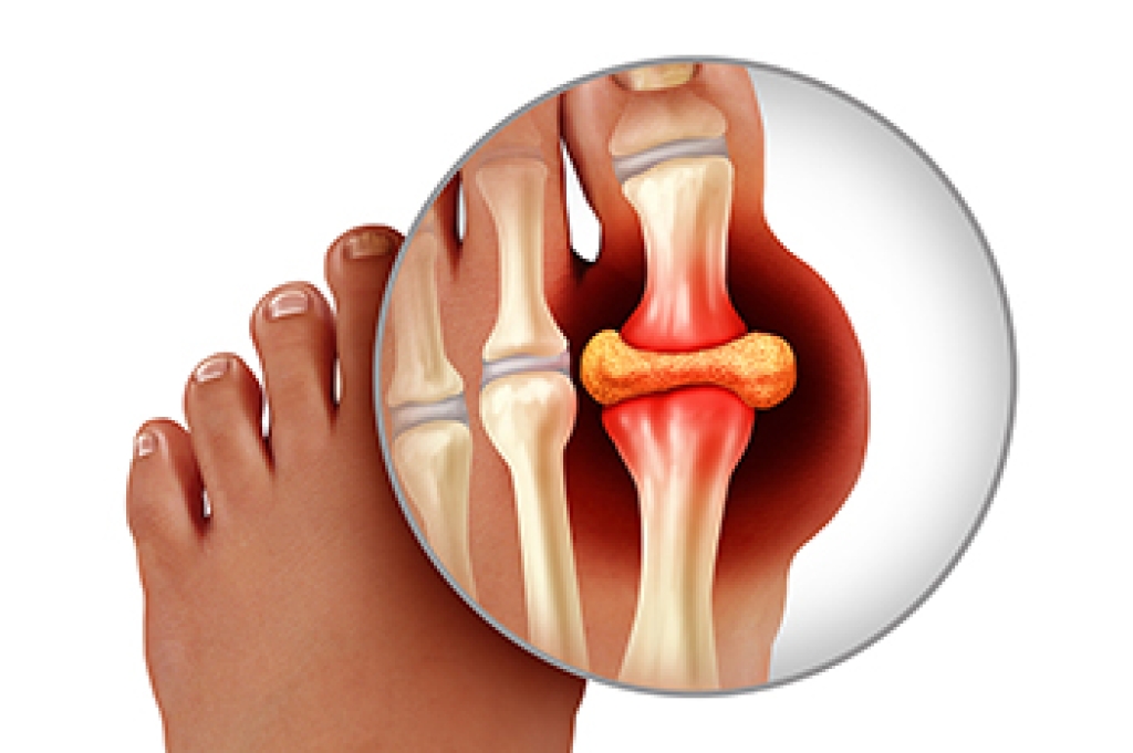 What Gout Is and Why It Affects the Big Toe