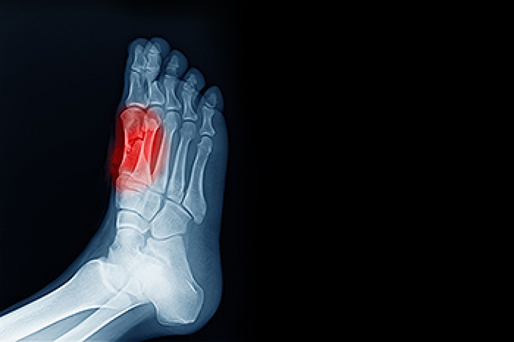 Sesamoiditis and Pain Beneath the Big Toe