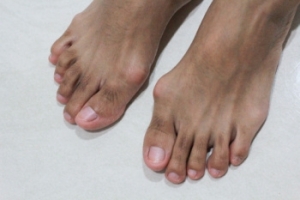 Bunion Complications