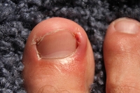 Unraveling the Causes of Ingrown Toenails