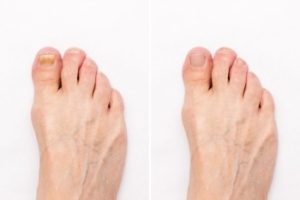 Understanding Contagion Risks of Toenail Fungus