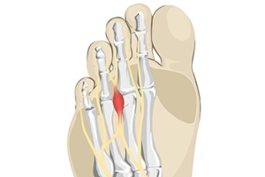 Morton’s Neuroma Remedies