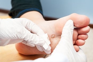 Ways of Treating Plantar Warts