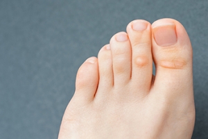 Removing Corns on the Feet