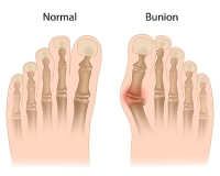 Facts About Bunions