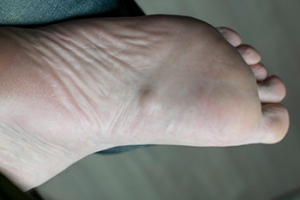 Understanding Plantar Fibromatosis  and Ledderhose Disease