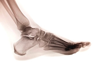Walking With a Foot Stress Fracture