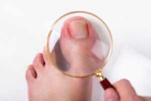 Dealing With Painful Ingrown Toenails