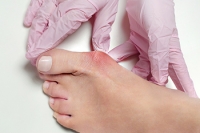 Genetics and Wearing High Heels May Cause Bunions