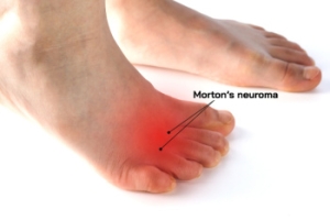 Understanding Morton&#039;s Neuroma